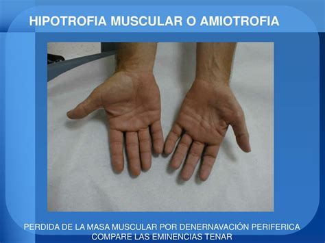hipotrofia muscular-4
